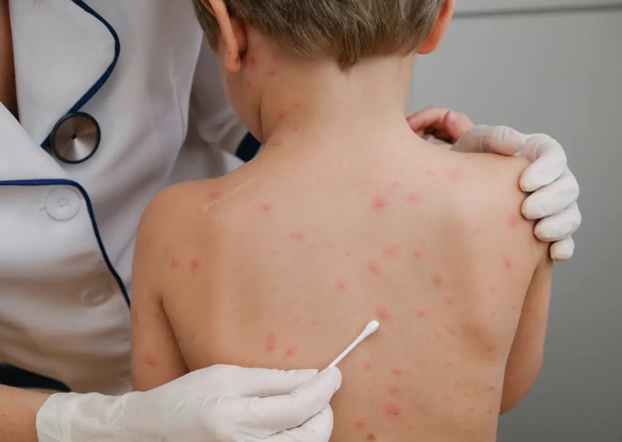 Šuga se širi Hrvatskom: Novi slučajevi u Dubrovačko-neretvanskoj županiji