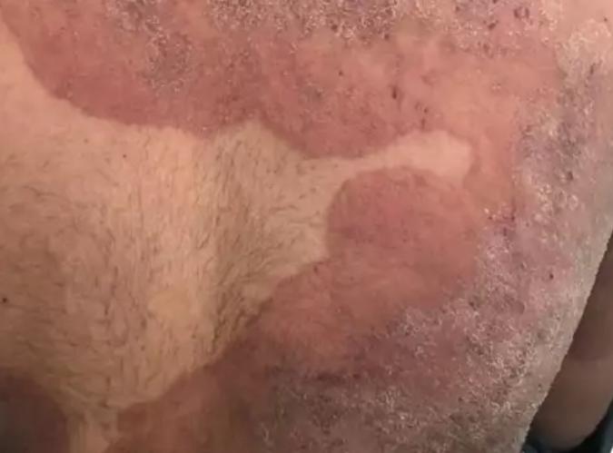 "Super-gljivica" koja napada stidna područja širi se Evropom