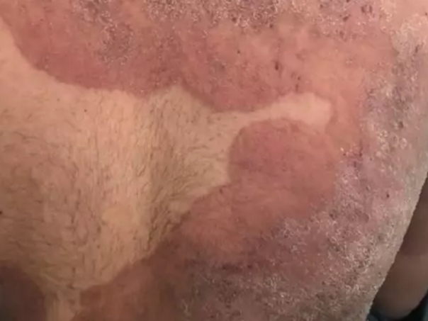 "Super-gljivica" koja napada stidna područja širi se Evropom