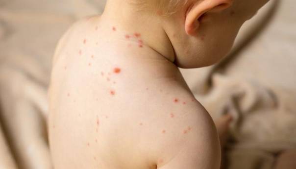 Svijetu prijeti opasnost od nove epidemije morbila