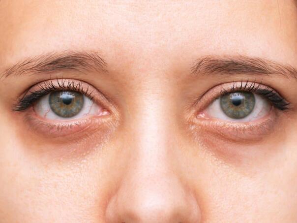 Tamni kolutovi ispod očiju mogu biti alarm za posjetu ljekaru