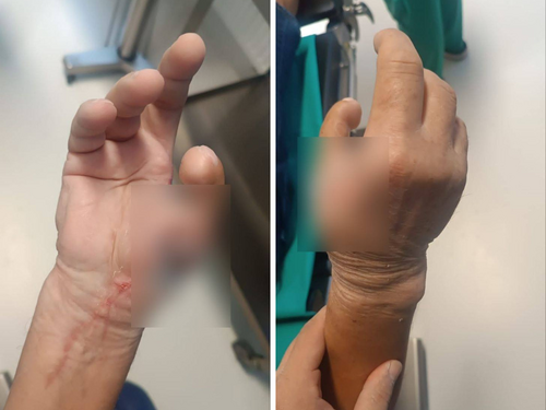 Tim UKC-a RS transplantirao pacijentu prst stopala na šaku