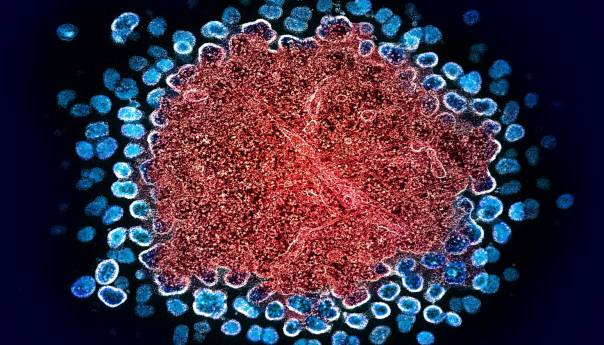 Treći pacijent izliječen od HIV-a