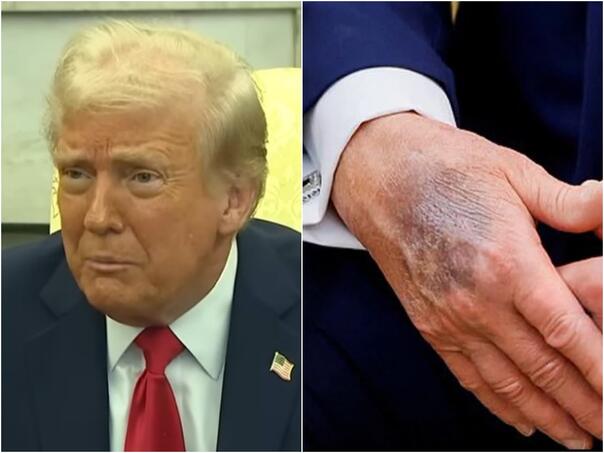 Trumpove ruke ponovo u fokusu: Bijela kuća ne spominje šminku na modricama