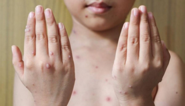 U 11 zemalja potvrđeno 80 slučajeva majmunskih boginja