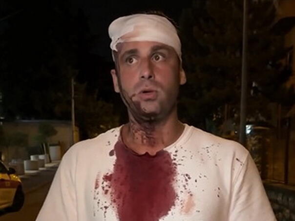 U Beogradu pretučen zastupnik: Šipkama su me udarali po glavi