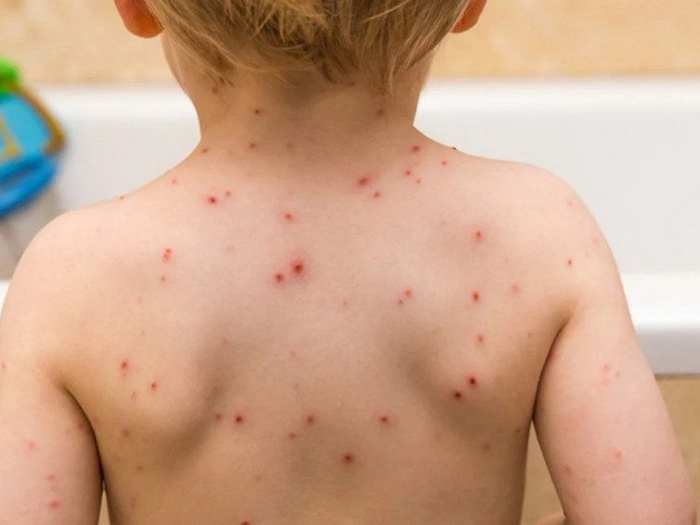 U Bijeljini proglašena epidemija morbila