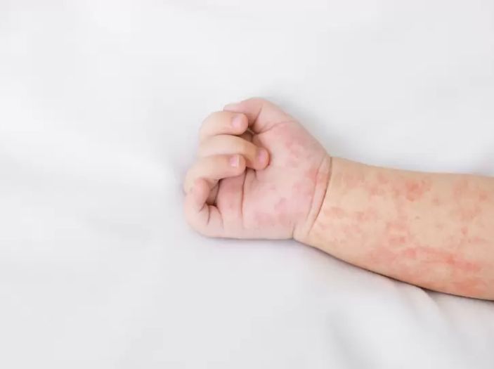 U Bugarskoj hara epidemija morbila: Djeca najugroženija kategorija