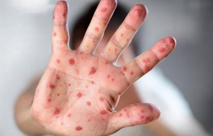 U Evropi neophodna hitna i ciljana vakcinacija protiv morbila