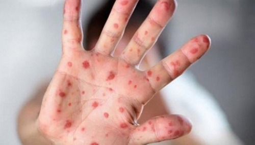 U Evropi neophodna hitna i ciljana vakcinacija protiv morbila