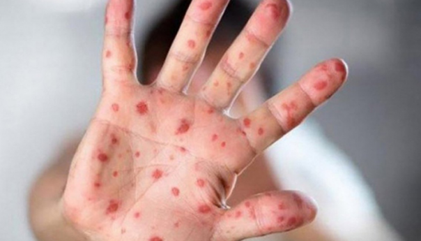 U Evropi neophodna hitna i ciljana vakcinacija protiv morbila