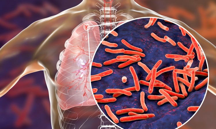 U HNK zabilježen pad broja oboljelih od tuberkuloze