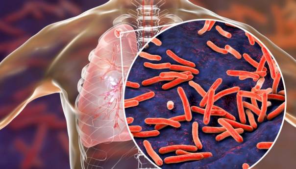 U HNK zabilježen pad broja oboljelih od tuberkuloze