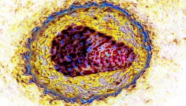 U SAD-u prva žena izliječena od AIDS-a