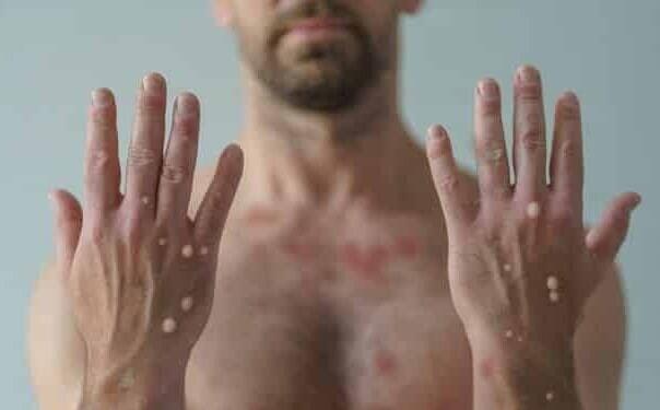 U Sijera Leoneu više od 3.000 slučajeva majmunskih boginja, 14 preminulih