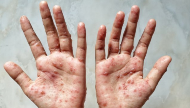 U Sloveniji potvrđen prvi slučaj majmunskih boginja