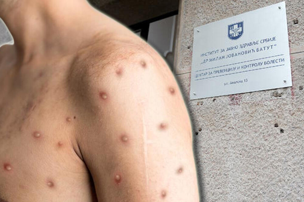 U Srbiji registrovan prvi slučaj majmunskih boginja