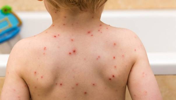 U Srbiji registrovano 47 slučajeva morbila