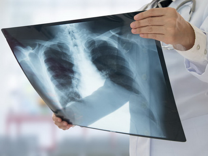 U susret Svjetskom danu borbe protiv raka pluća: Neophodan nacionalni skrining program