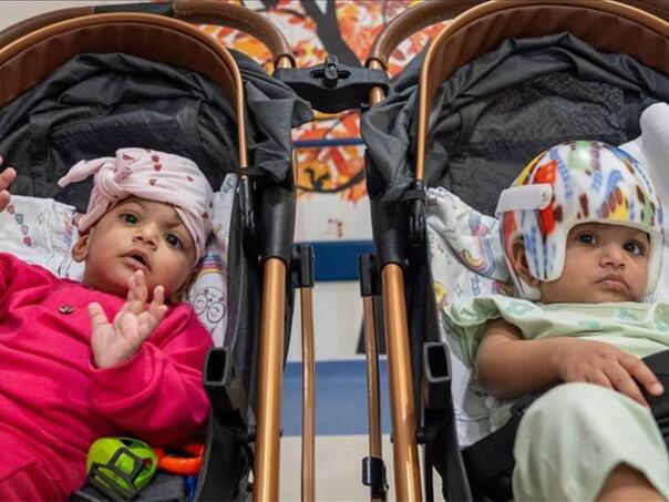 U Turskoj uspješno rastavljene sijamske bliznakinje, operacija trajala 14 sati