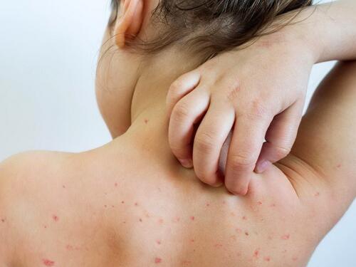 U ZDK 839 slučajeva morbila, najviše u Kaknju, Zenici i Visokom