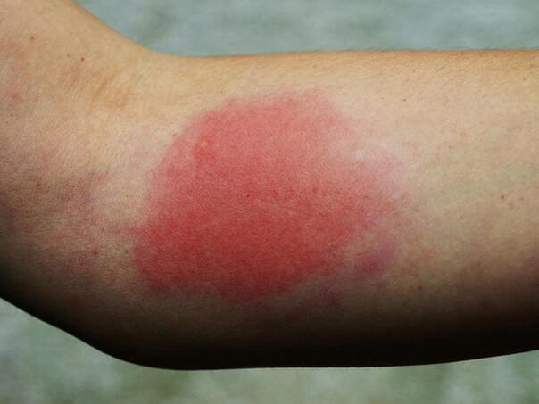 Ubod ose može da bude smrtonosan: Evo kako da na vrijeme prepoznate reakciju