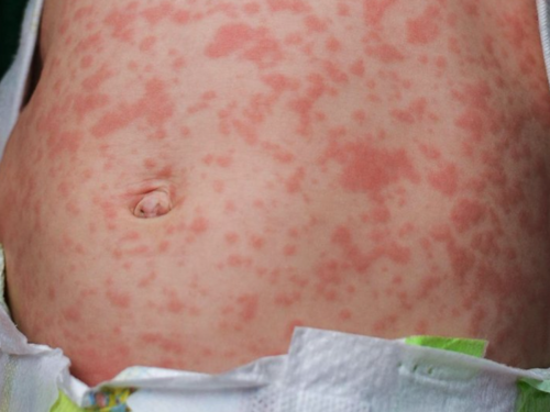 Upozorenje putnicima: Nagli porast malih boginja u Evropi i svijetu