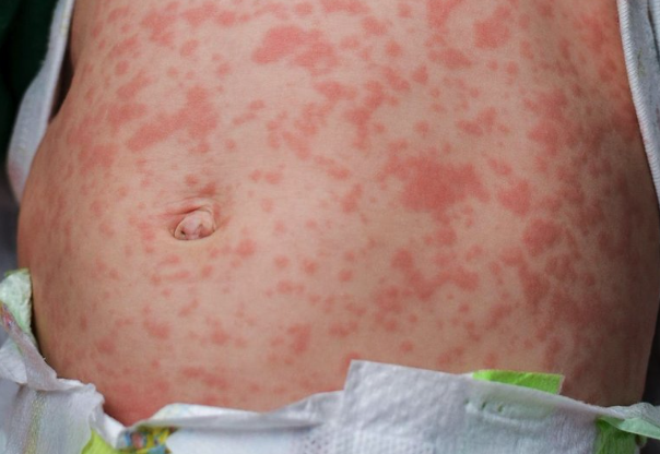 Upozorenje putnicima: Nagli porast malih boginja u Evropi i svijetu