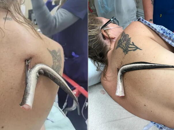 Uznemirujući snimak: Ženu napala riba, bodlja joj se zabila u leđa