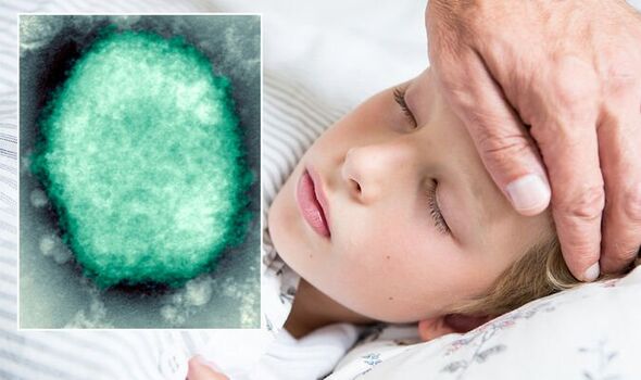 Virus majmunskih boginja prvi put zabilježen kod djece u SAD-u