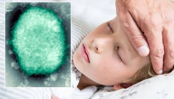 Virus majmunskih boginja prvi put zabilježen kod djece u SAD-u