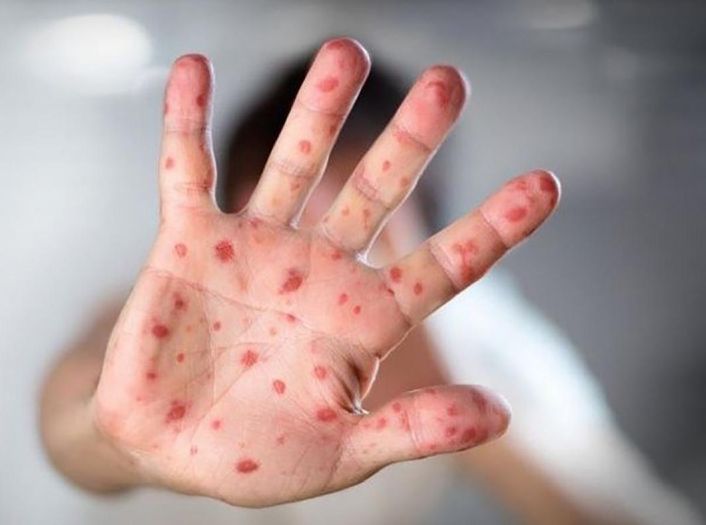 Više od 1.500 djece u Kantonu Sarajevo vakcinisano protiv morbila za sedam dana