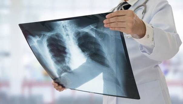 Više od četvrtine mladih sa koronavirusom dobilo upalu pluća