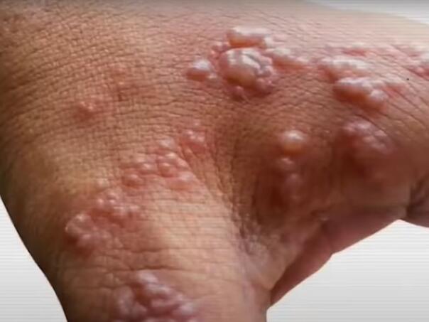 WHO: Epidemija majmunskih boginja je globalna opasnost