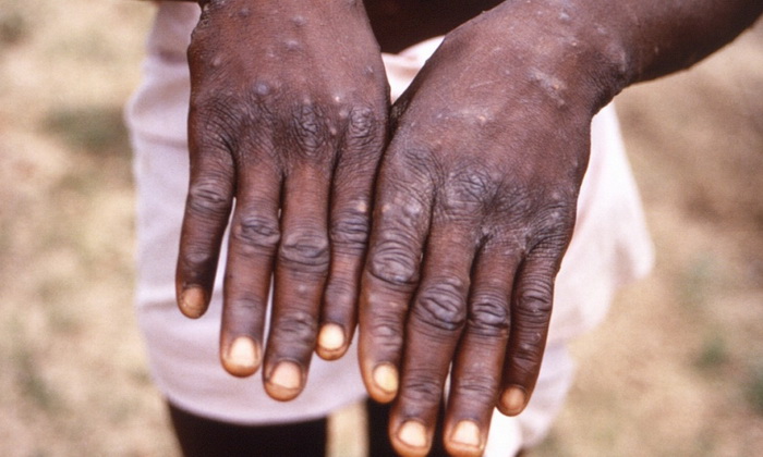 WHO: Epidemija majmunskih boginja ostaje globalna zdravstvena prijetnja