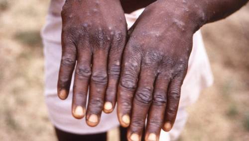 WHO: Epidemija majmunskih boginja ostaje globalna zdravstvena prijetnja